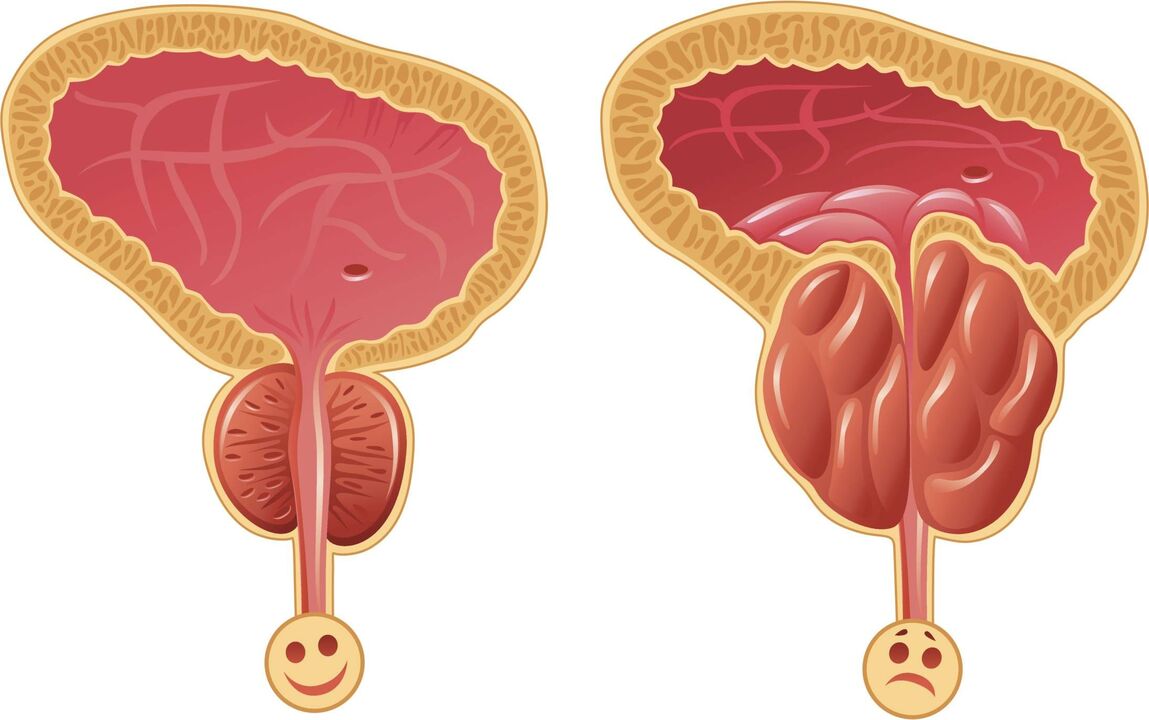 Razóns para o desenvolvemento da prostatite