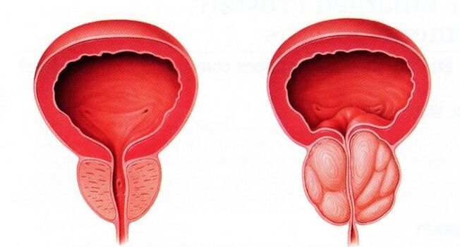 próstata saudable e inflamado con prostatite crónica